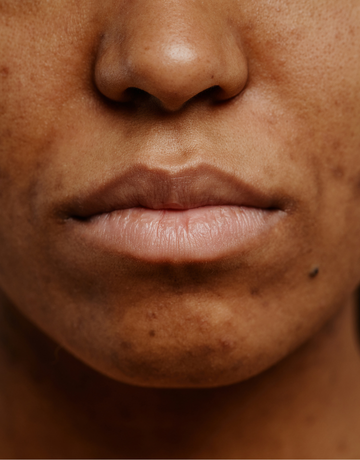 Treatment guidelines for acne