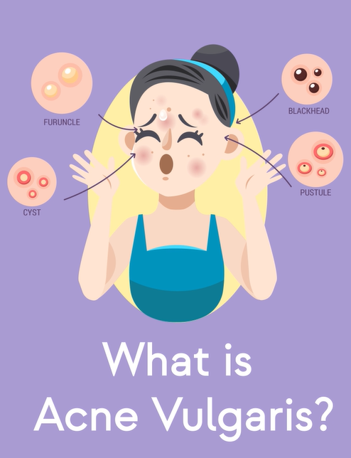 Acne vulgaris