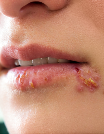 Treatment guidelines for cold sores