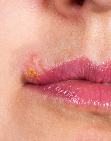 Cold Sores in Community Pharmacy: Recognition, Assessment & Differential Diagnosis