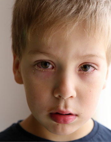 Treatment guidelines for conjunctivitis