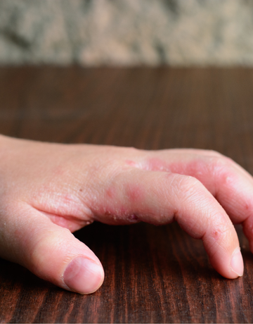Treatment Guidelines for Dermatitis