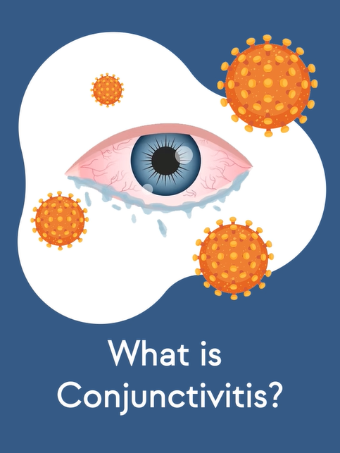 Conjunctivitis