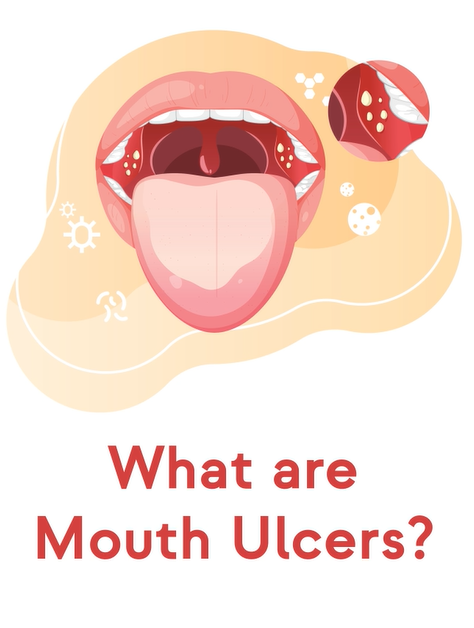 Mouth Ulcers